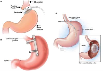 Efficacy and Mechanisms of Gastric Volume-Restriction Bariatric Devices